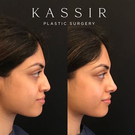 What Is A Liquid Rhinoplasty Kassir Plastic Surgery In Ny And Nj