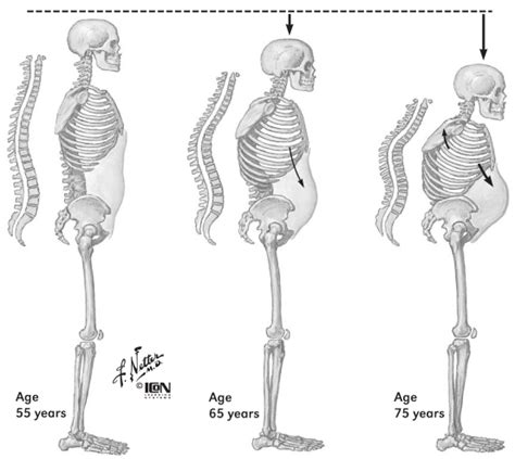 Figure Progressive Spinal Deformity In Osteoporosis Bone Health