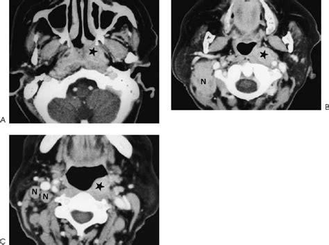 Tumor Spread Into The Retropharyngeal Space Radiology Key
