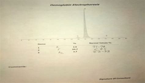 Figure Hemoglobin Electrophoresis Showing Beta Thalassemia Major