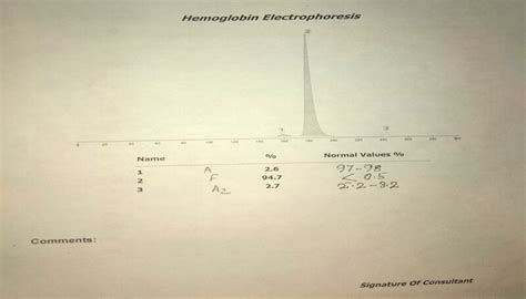 Figure Hemoglobin Electrophoresis Showing Beta Thalassemia Major Contributed By Anam Khan Md