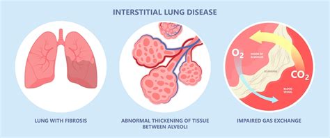 Interstitial Lung Disease – Dr. Gopal Chawla