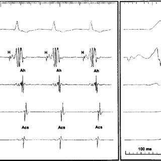 Left: 12 lead ECG of AVNRT with visible retrograde P wave in a woman of... | Download Scientific ...