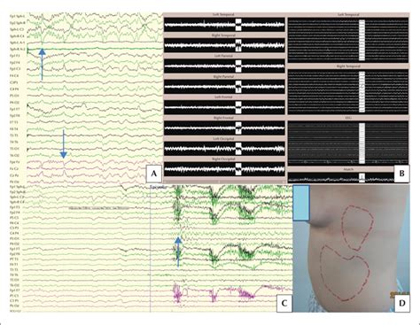 JLE Epileptic Disorders Focal Epilepsy With Paroxysmal Pain Due To