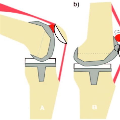 Arthrofibrosis Knee Stiffness Following Total Knee Arthroplasty