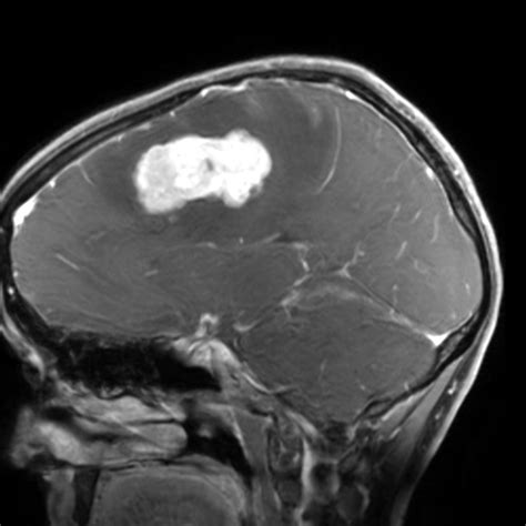 Solitary Fibrous Tumor Hemangiopericytoma Image Radiopaedia Org