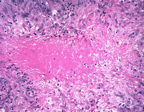 Hematoxylin And Eosin Stained Histological Section Showing Granuloma