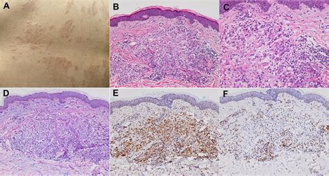 A Domed Shaped Mild Indurated Erythematous Papules With Smooth Download Scientific Diagram