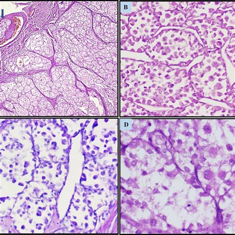 Alveolar Soft Part Sarcoma A Tumor Cells Arranged In Alveolar Pattern