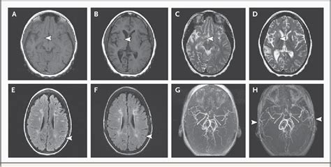 [PDF] Moyamoya disease and moyamoya syndrome. | Semantic Scholar