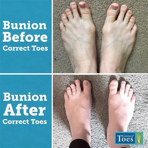 What Are Toe Spacers Do Toe Spacers Work Natural Foot Health