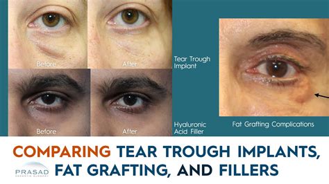 Under Eye Hollows Comparing Under Eye Filler Tear Trough Implants