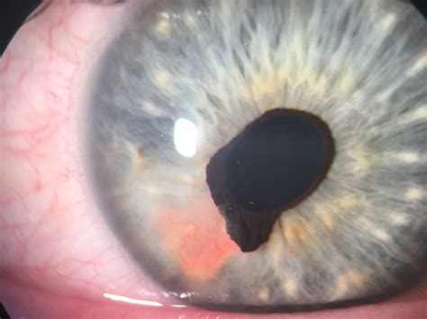 Clinical photography: Iris melanoma - Spectrum ANZ