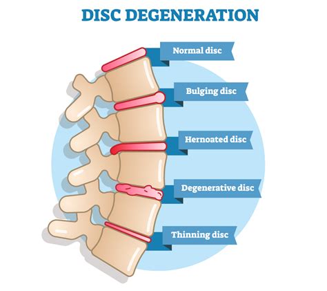 Herniated Disc Causes Symptoms Treatment And Prevention Proactive