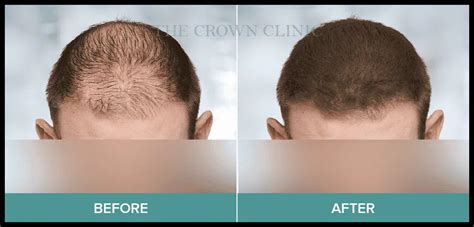 Hair Loss Medications And Treatments Crown Clinic