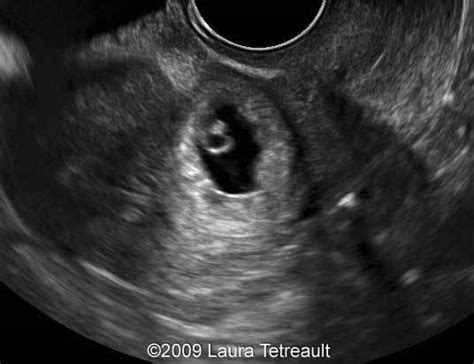 📃 Cesarean-section scar, ectopic pregnancy