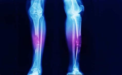 Everything You Need to Know About Bone Cancer: Overview, Causes, Types, Signs and Symptoms ...