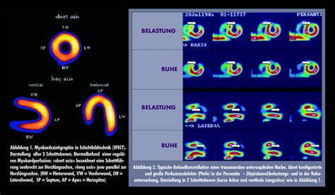 Myokardperfusionsszintigraphie Bei Koronarer Herzerkrankung