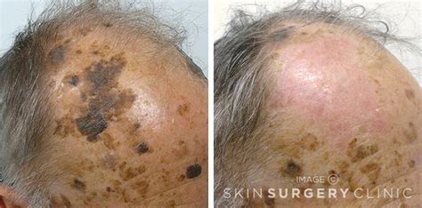 Seborrheic Keratosis Face Removal