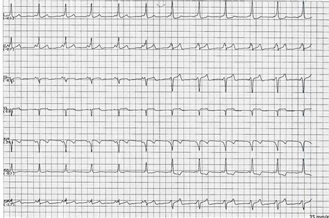 Ecg Rhythms The Concertina Effect Of Pre Excitation