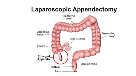 Laparoscopic Appendectomy Nyc General Surgeon Best General Surgeons Nyc