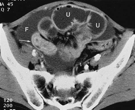 Ct Evaluation Of Small Bowel Obstruction Radiographics