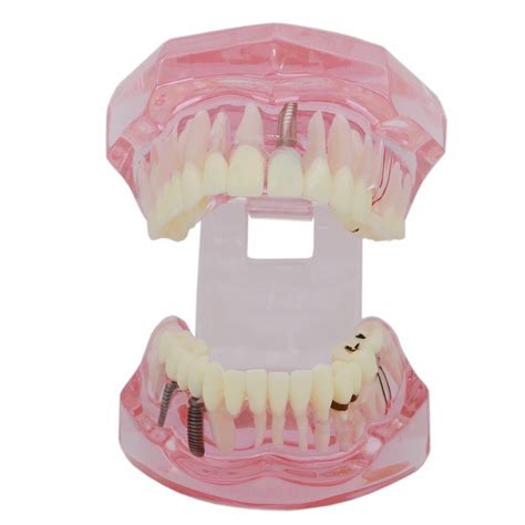 Snapklik Dentalmall Teeth Model Teeth Typodonts Dental Implant