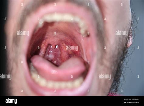 Canker Sore On Uvula