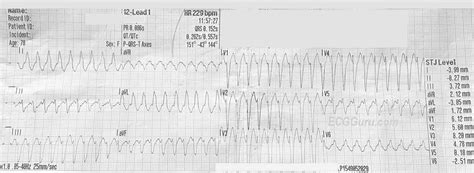 Wide Complex Tachycardia Ecg Guru Instructor Resources