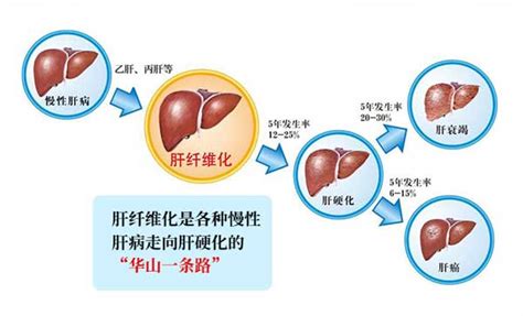 肝病患者福音辽沈肝纤维化防治新叶项目工程启动 名医汇