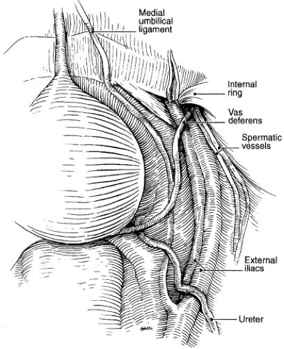 Laparoscopic Pelvic And Retroperitoneal Lymph Node Dissection