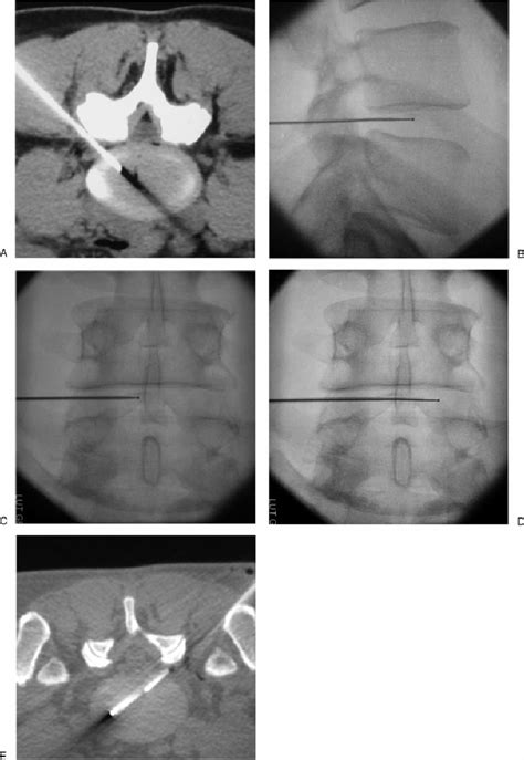 Percutaneous Lumbar Radiofrequency Nucleoplasty A A Gauge