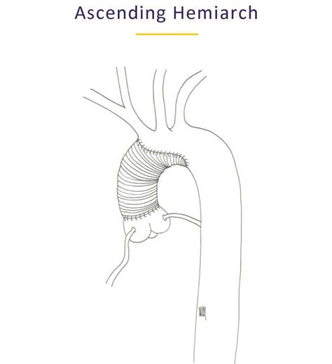 Thoracic Aneurysm And Dissection Uwmtap