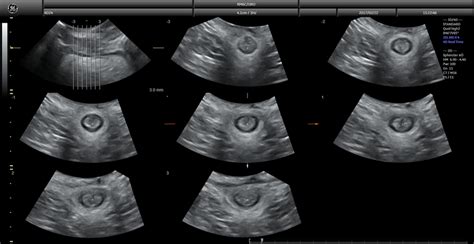 Transperineal Ultrasound Transperineal Ultrasound Of The Anal