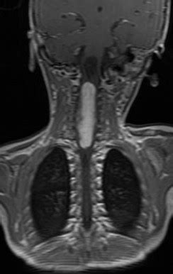 Cord Astrocytoma Sumer S Radiology Blog