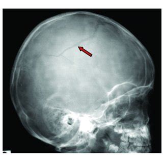 Linear right parietal skull fracture. | Download Scientific Diagram