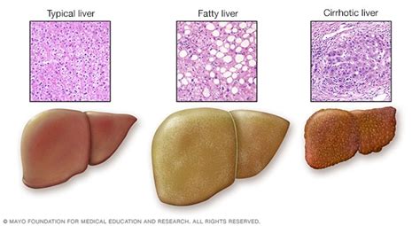 مشكلات الكبد الأعراض والأسباب Mayo Clinic مايو كلينك