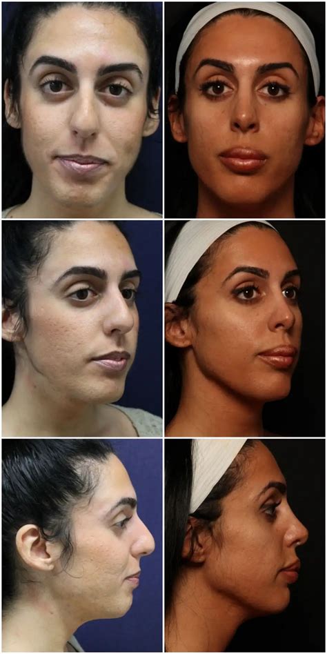 Laser Skin Resurfacing New Jersey The Breslow Center