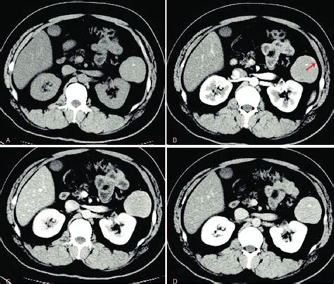 A Nonenhanced Computed Tomography An Isodense Tumor With