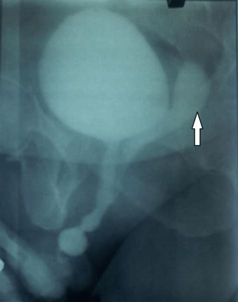 Voiding Cysturethrogram Showing Utricle Cyst Posterior To Bladder And