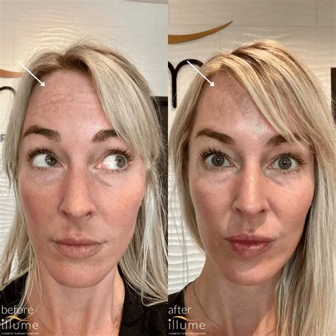 Botox Before After Photos Illume Cosmetic Surgery MedSpa