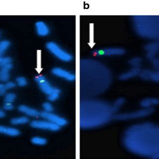 FISH Analysis With Commercial Probes Vysis WolfHirschhorn Region