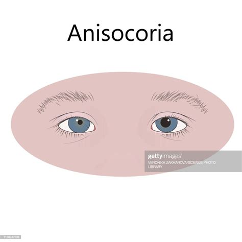 Childhood Anisocoria Illustration High-Res Vector Graphic - Getty Images