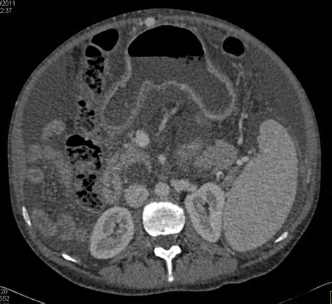 Cirrhosis With Portal Hypertension And Recanalization Of The Umbilical