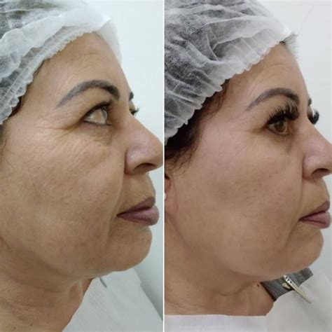 Skinbooster Facial Clínica De Estética Facial