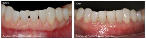 Pinhole Treatment For Receding Gums Philadelphia