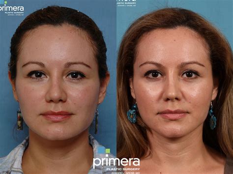 Revision Rhinoplasty Before And After Pictures Case 233 Orlando