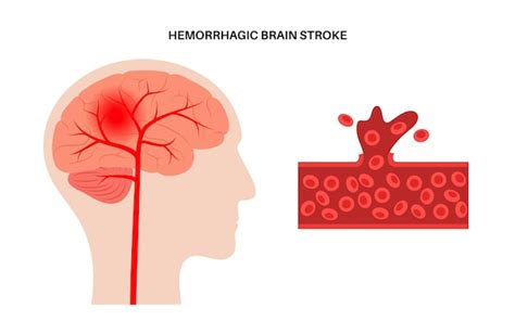 Premium Vector Brain Stroke Ishemic And Hemorrhagic