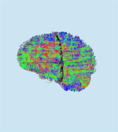 Transcranial Magnetic Stimulation Tms Connectomix