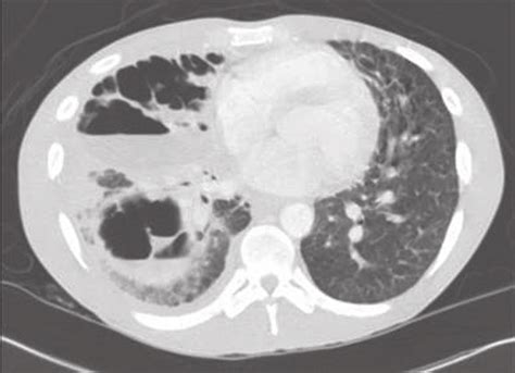 Thoracic Ct Scan Of The Mid And Lower Lung Zones Showing The Extent Of